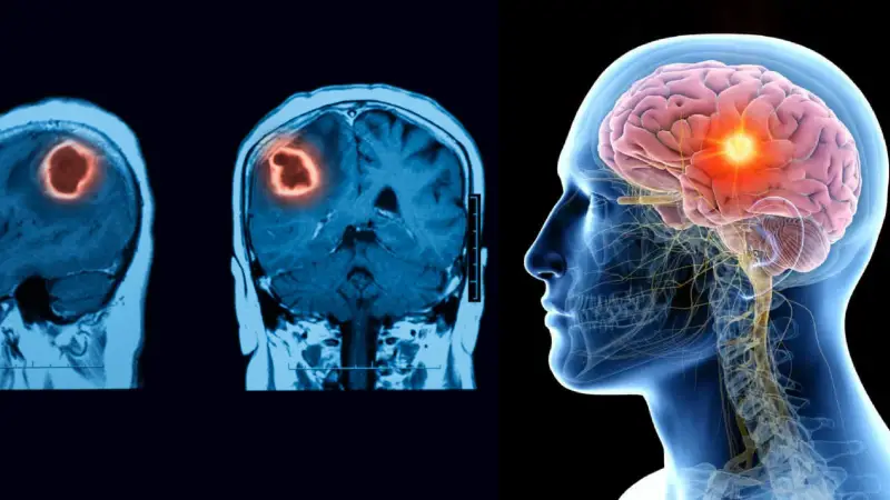 মস্তিষ্কে টিউমারের ইঙ্গিত দিচ্ছে যে ৫টি সূক্ষ্ম উপসর্গ!