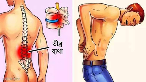 কোমর ব্যথার প্রধান ৩টি কারণ এবং চিকিৎসা!