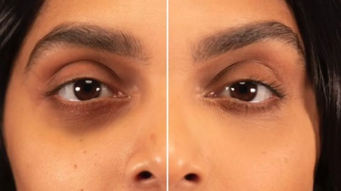 চোখের নিচের কালো দাগ কখন ভয়াবহ রোগের লক্ষণ? যা বলছে গবেষণা